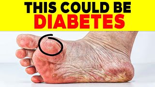 ALERT 18 SIGNS of DIABETES on THE SKIN that FEW PEOPLE KNOW  110 [upl. by Emmie77]