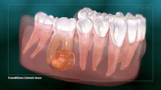 Dental Abcess  Why Root Canal Treatment Is Needed [upl. by Vories]