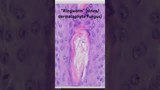 “Ringworm” under the microscope Tinea dermatophyte fungus skin infection it’s not really a worm [upl. by Adon]