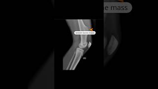 Osteochondroma  sessile xray knee shortfeed [upl. by Assirec]