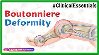 Boutonnière Deformity Swan neck Deformity Elson test Mallet finger  Animated Clinical essentials [upl. by Eleahcim]