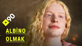 Albino olmak  quotGözlerim titrese de kaysa da kameranın karşısındayımquot [upl. by Atirec]