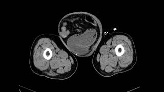 Case 7 73 year old male patient with abdominal pain [upl. by Eicrad175]