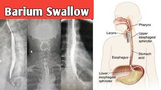 Barium Swallow complete study and technique and cases review [upl. by Karole808]