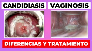 COMO DIFERENCIAR LA CANDIDIASIS DE LA VAGINOSIS BACTERIANA  TRATAMIENTO [upl. by Eytak]