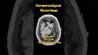 Brain Hemorrhage Bleed hemorrhage bleed radiology brain xray ctet [upl. by Ydac617]