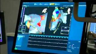 3D Electrical Mapping of the Heart [upl. by Aitnas]