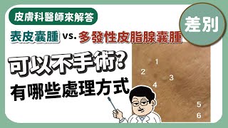 【皮膚專科醫師來解答】多發性皮脂腺囊腫與粉瘤如何區分一定要治療嗎治療方式又有哪些是否有微創手術 [upl. by Nnaeed]