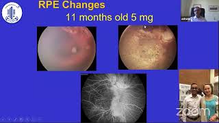 Intraarterial Chemotherapy for Retinoblastoma Current StatusDr Ashwin Reddy [upl. by Priest251]