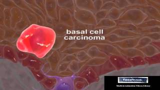 Basal Cell Carcinomas Medical Animation Video 3D [upl. by Aihseuqram646]