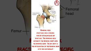 HIP HEMIARTHROPLASTY [upl. by Georgeanna]