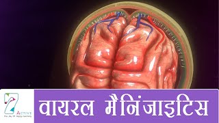 वायरल मैनिं जाइटिस  Viral Meningitis  Hindi [upl. by Alrzc]