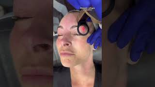 CO2 Laser Resurfacing Around The Eyes  Dr Medispa [upl. by Brigham775]