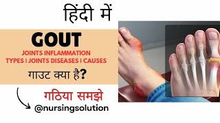 Gout in hindi  Joint inflammation disease in hindi  Types  Causes  Symptoms  Treatment [upl. by Falzetta]