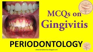 MCQs in Periodontology  Gingivitis [upl. by Corena]