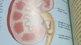 HDF is live Renal calculi [upl. by Grishilde]