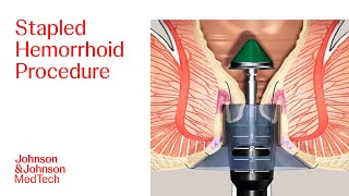 PPH Procedure Animation  Stapled Hemorrhoid Surgery  JampJ MedTech [upl. by Adorl855]