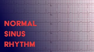 Determine HR from a RegularRhythm EKG  1500 amp 300methods [upl. by Orvan]