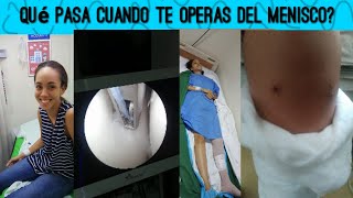 Operación de menisco artroscopia de rodillaCausas de dolor en la rodilla rotura recuperación [upl. by Aicertal359]