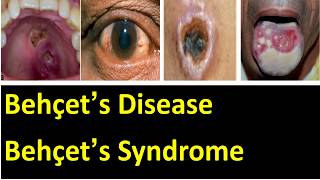 Behçet’s disease  behçet’s syndrome cause symptoms pathology diagnosis and treatment [upl. by Sarajane]