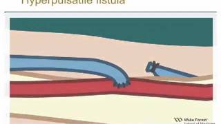 Physical Examination of Arteriovenous Fistula [upl. by Noraj]