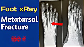 How to read Fracture of XRay FootMetatarsal Fractureपैर का फैक्चर एक्सरे कैसे देखेंUdayXray [upl. by Silverstein]