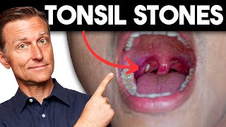 Tonsil Stones Removing the Deeper Cause [upl. by Yhtommit]