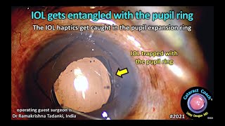 CataractCoach™ 2021 IOL gets entangled with the pupil ring [upl. by Cain253]