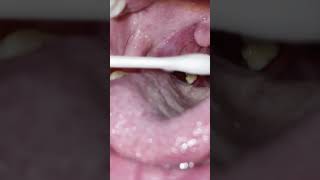 Tonsil stones 58 [upl. by Rehtaef721]