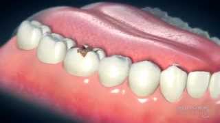 Dental Crowns Everything You Need to Know [upl. by Yelrebma445]