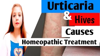 Urticaria amp Hives पित्ती उछलना  Symptoms Causes amp Homeopathic Treatment of Itchy Skin Rashes [upl. by Nannahs]