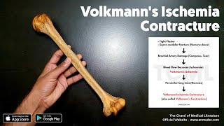 Volkmanns ischaemia amp Volkmanns contracture  Dr Pawan nagar [upl. by Ahola477]