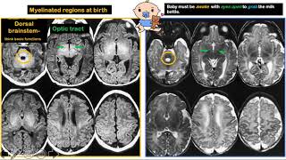 Myelination in MRI 24 simplified [upl. by Ibrik]