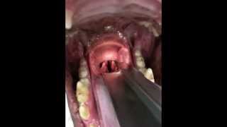 Laryngeal paralysis oral exam [upl. by Sweeney]