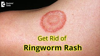 7 GREAT Tips for Prevention amp Treatment of RINGWORM RASH Dr Amrita Hongal Gejje  Doctors Circle [upl. by Nahoj]