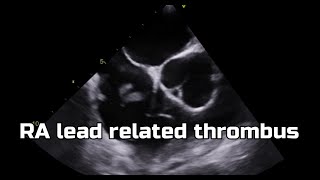 Thrombus in RA lead [upl. by Avilla986]