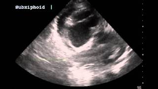 Right atrial systolic collapse indicating early tamponade physiology [upl. by Tisha]