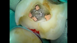 64 4 Canal Upper Molar Root Canal and Crown Prep [upl. by Mason454]