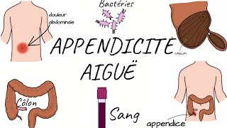 LAPPENDICITE AIGUË physiopathologie symptômes diagnostic traitement [upl. by Klemm]