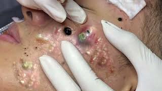 Big Cystic Acne Blackheads Extraction Blackheads amp Milia Whiteheads Removal Pimple Popping 11 [upl. by Wilder467]