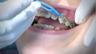 How to Wear Orthodontic Elastic Bands [upl. by Rossner]