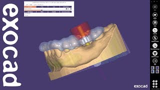 exocad Quick Guide Get most out of guided surgery [upl. by Atteuqnas371]