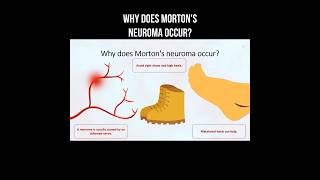 Why does Mortons neuroma occur morton neuroma inflammation nervepainrelief [upl. by Crystie862]