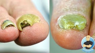 CUTTING AND TRIMMING SUPER THICK TOENAILS HOW TO MANAGE HARD TO CUT TOENAILS [upl. by Jehiah]