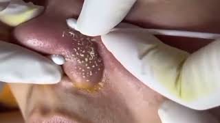 remove blackheads from nose  blackhead acne pimple  how to remove small pimples on nose [upl. by Sessilu]