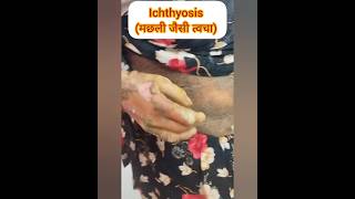 ICHTHYOSIS दुर्लभ त्वचा रोग raredisease dryskin dryness itching shortsfeed shortvideo dry [upl. by Reifnnej]