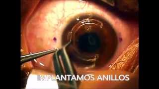 CIRUGÍA CORNEAL ANILLOS INTRAESTROMALES [upl. by Dareen180]