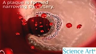 How Atherosclerosis Develops  Process of Atherosclerosis Plaque Formation Animation  Pathology [upl. by Holder]