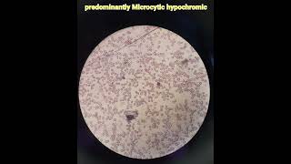 Hematologyanaemiamicrocytic hypochromicpathologymedical [upl. by Diraj]