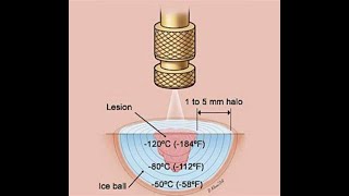 Cryotherapy or Cryoablation or Cryosurgery or Cold therapy  Overview Indications Types Uses [upl. by Treboh43]